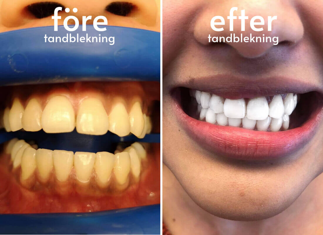 Tandblekning-före-efter